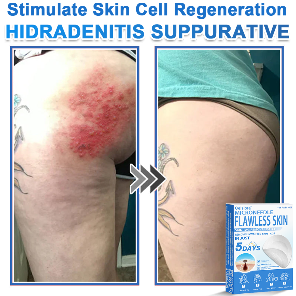 📌 Celsiora® 2-in-1 Microneedle & Hydrocolloid Patch | Raised Moles,Acne,  Flat Warts & Skin Tags Remover | Improves Wrinkles, Scars & Blemishes | Invisible Star Pimple Patches for Face & Body
