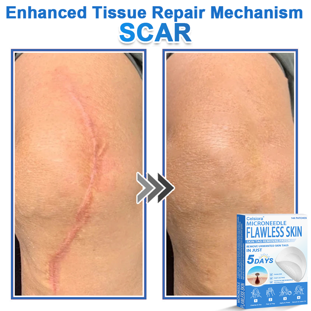 📌 Celsiora® 2-in-1 Microneedle & Hydrocolloid Patch | Raised Moles,Acne,  Flat Warts & Skin Tags Remover | Improves Wrinkles, Scars & Blemishes | Invisible Star Pimple Patches for Face & Body