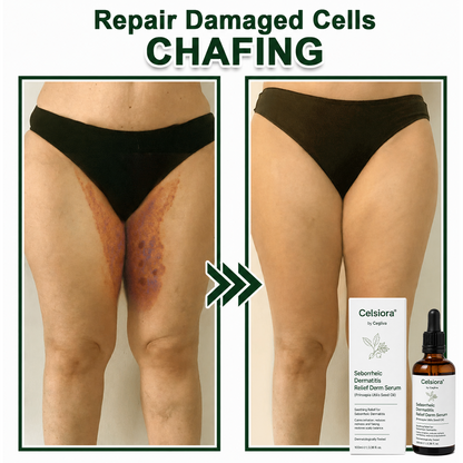 🍃Celsiora® Seborrheic Dermatitis Relief Derm Serum