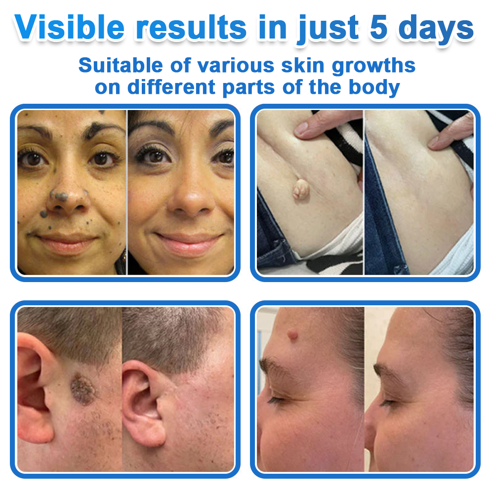 📌 Celsiora® 2-in-1 Microneedle & Hydrocolloid Patch | Raised Moles,Acne,  Flat Warts & Skin Tags Remover | Improves Wrinkles, Scars & Blemishes | Invisible Star Pimple Patches for Face & Body