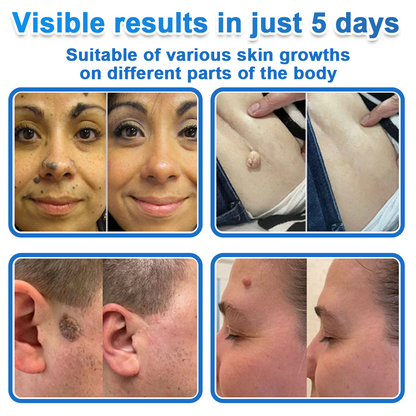 📌 Celsiora® 2-in-1 Microneedle & Hydrocolloid Patch | Raised Moles,Acne,  Flat Warts & Skin Tags Remover | Improves Wrinkles, Scars & Blemishes | Invisible Star Pimple Patches for Face & Body