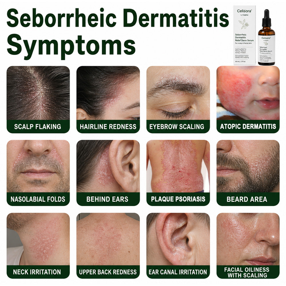 🍃Celsiora® Seborrheic Dermatitis Relief Derm Serum