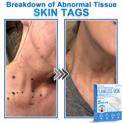 📌 Celsiora® 2-in-1 Microneedle & Hydrocolloid Patch | Raised Moles,Acne,  Flat Warts & Skin Tags Remover | Improves Wrinkles, Scars & Blemishes | Invisible Star Pimple Patches for Face & Body