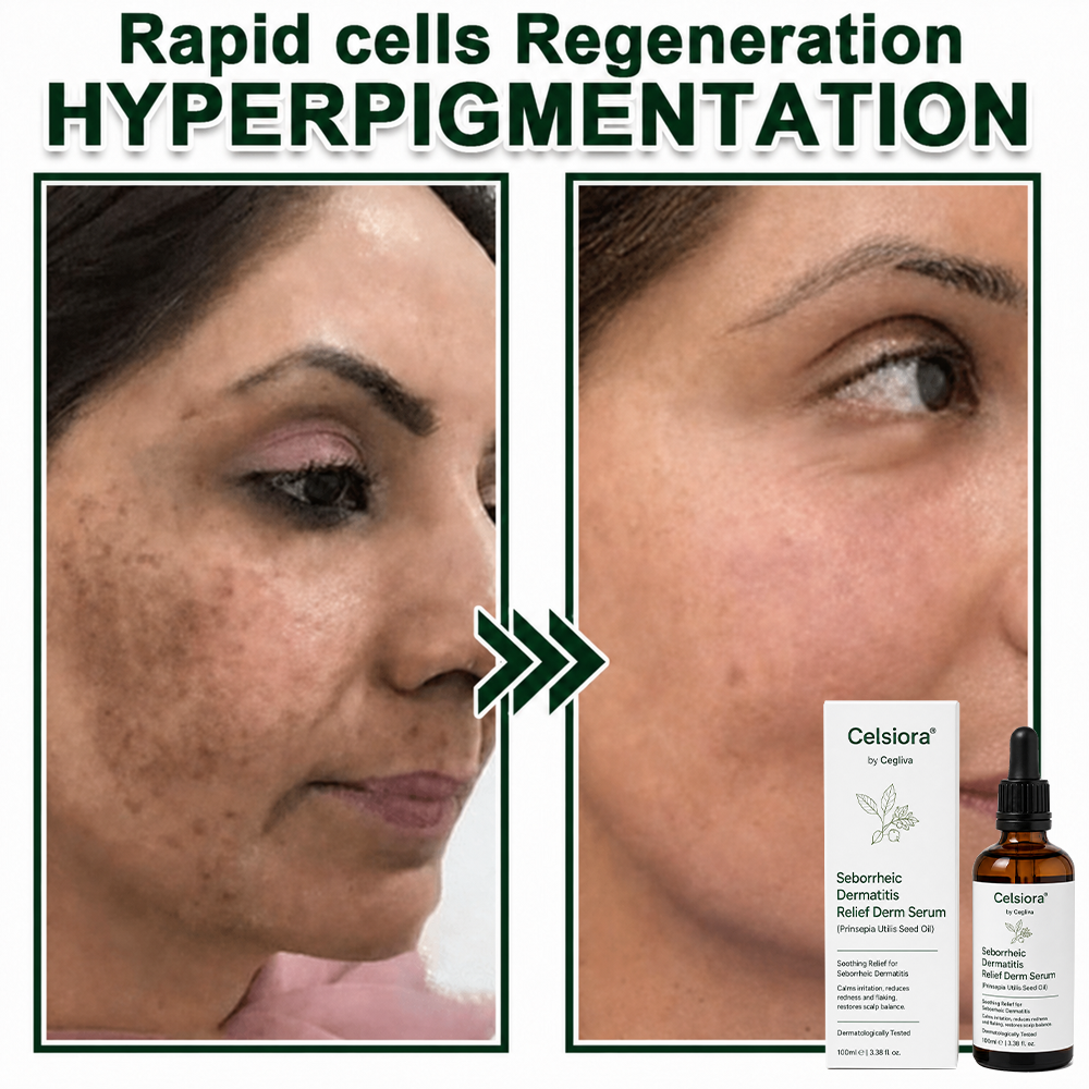 🍃Celsiora® Seborrheic Dermatitis Relief Derm Serum