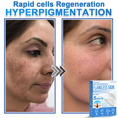 📌 Celsiora® 2-in-1 Microneedle & Hydrocolloid Patch | Raised Moles,Acne,  Flat Warts & Skin Tags Remover | Improves Wrinkles, Scars & Blemishes | Invisible Star Pimple Patches for Face & Body