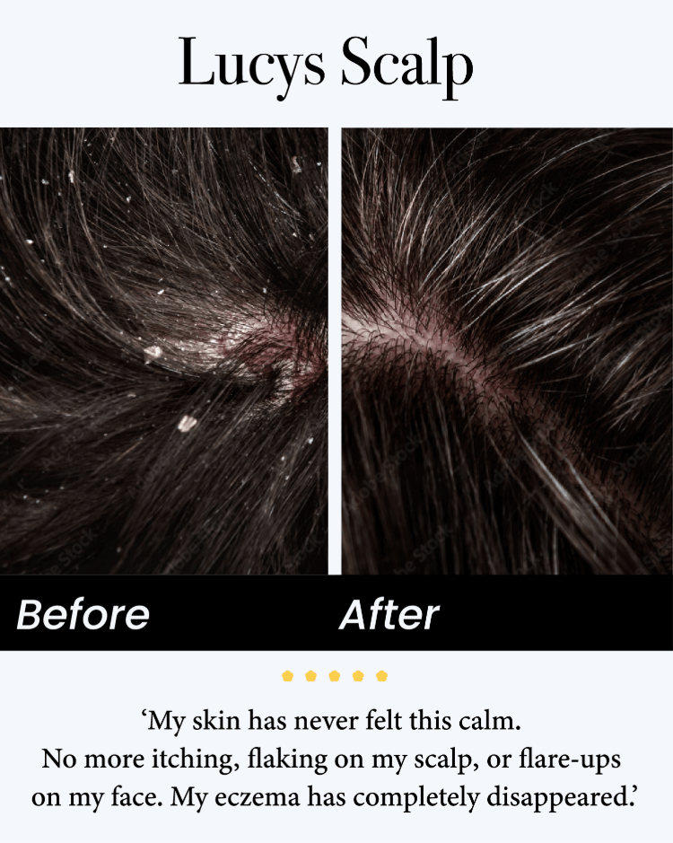 🍃Celsiora® Seborrheic Dermatitis Relief Derm Serum