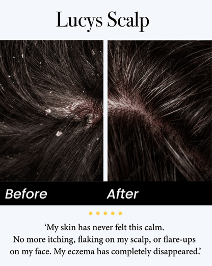 🍃Celsiora® Seborrheic Dermatitis Relief Derm Serum